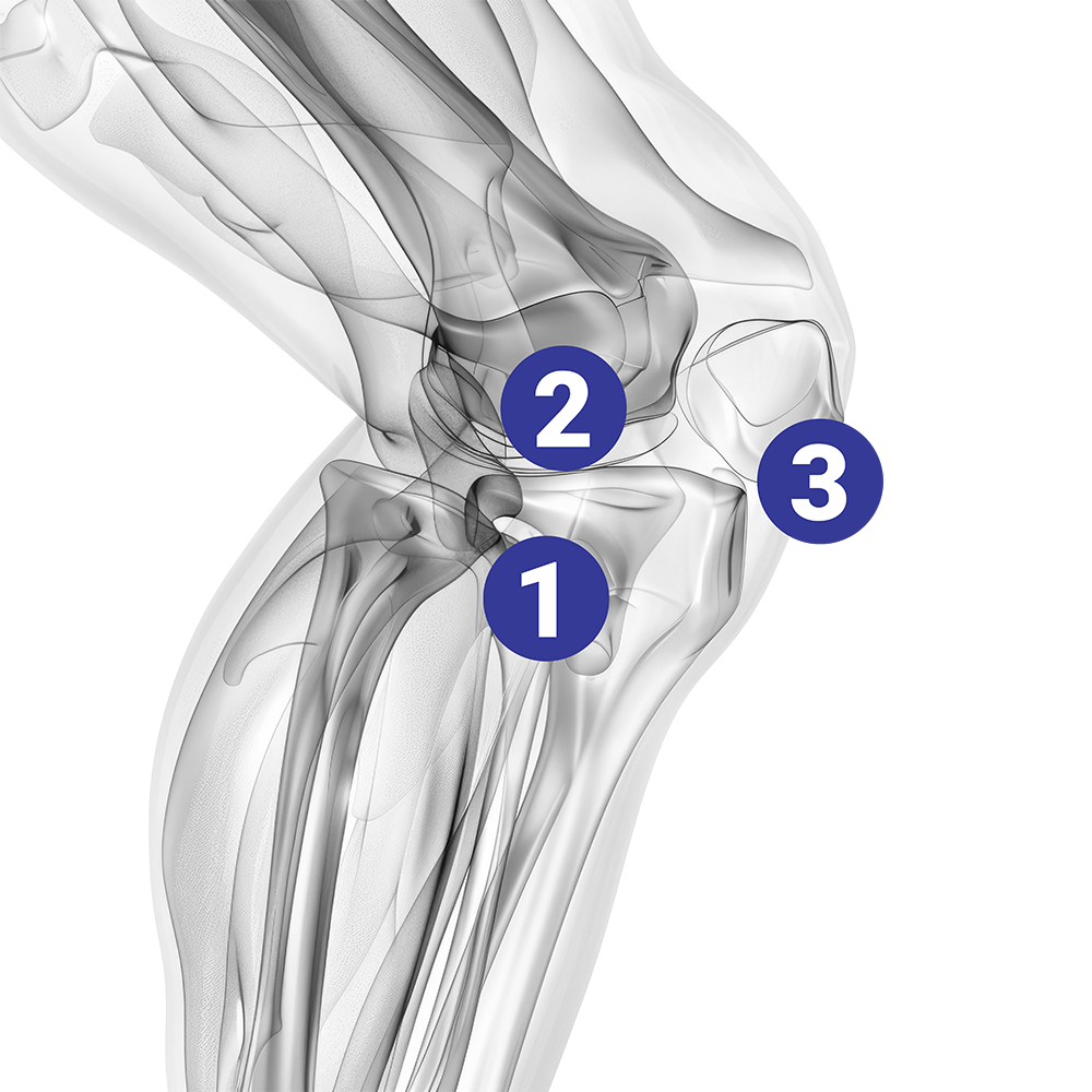 Illustration zu Kreuzband, Meniskus und Arthrose